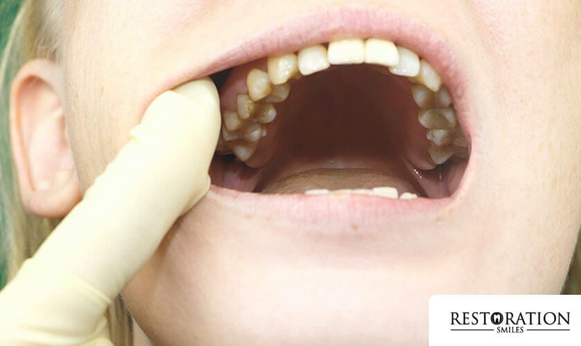 Oral Cancer Screening in Tomball, TX