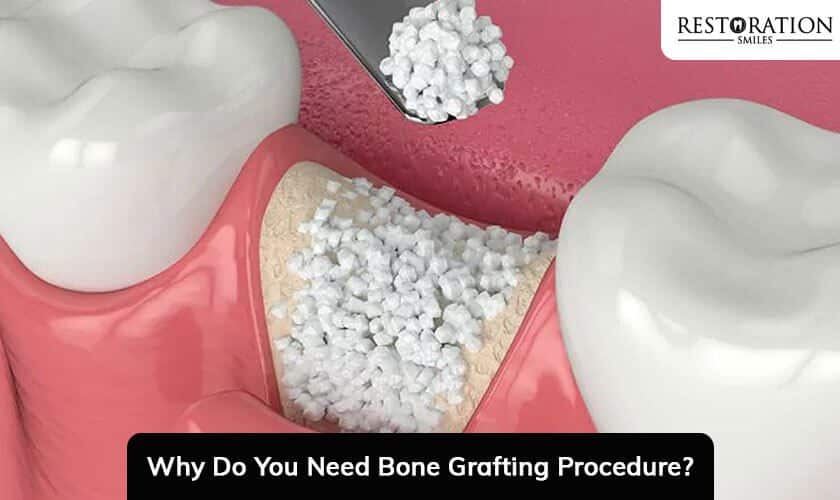 Why Do You Need Bone Grafting Procedure