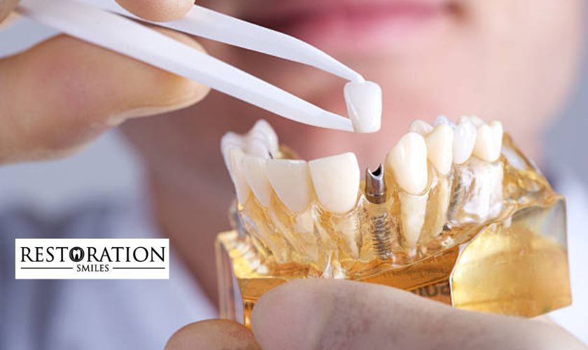 All About Full Mouth Dental Implants