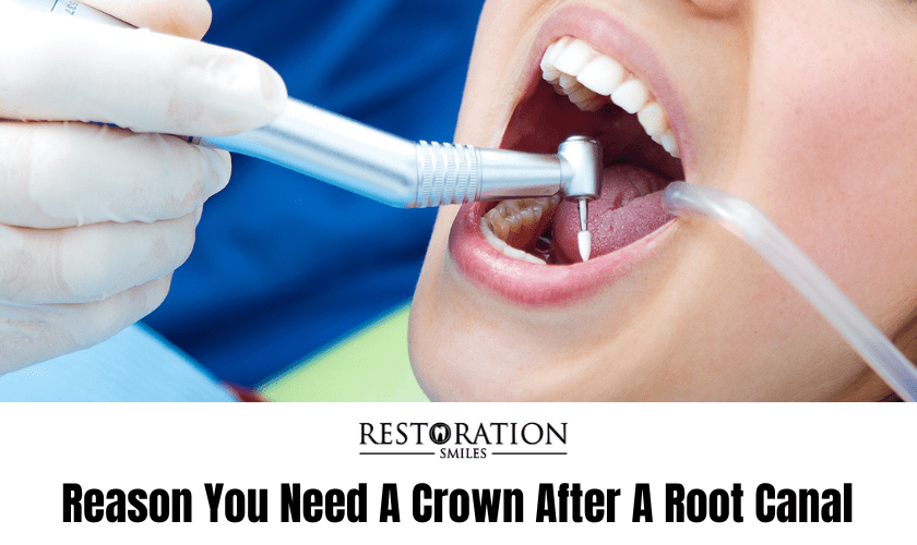 Reason You Need A Crown After A Root Canal