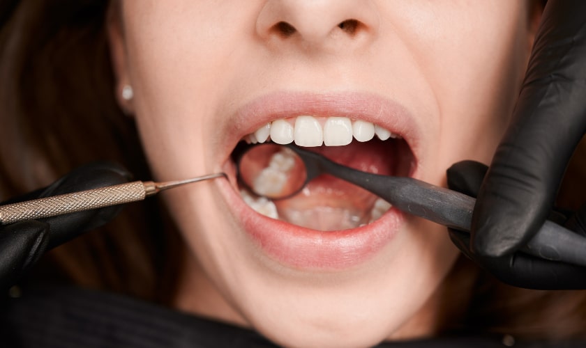 Porcelain Bridges is a Great Replacement for Missing Teeth
