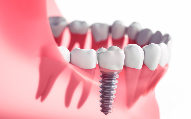 Dental Implants