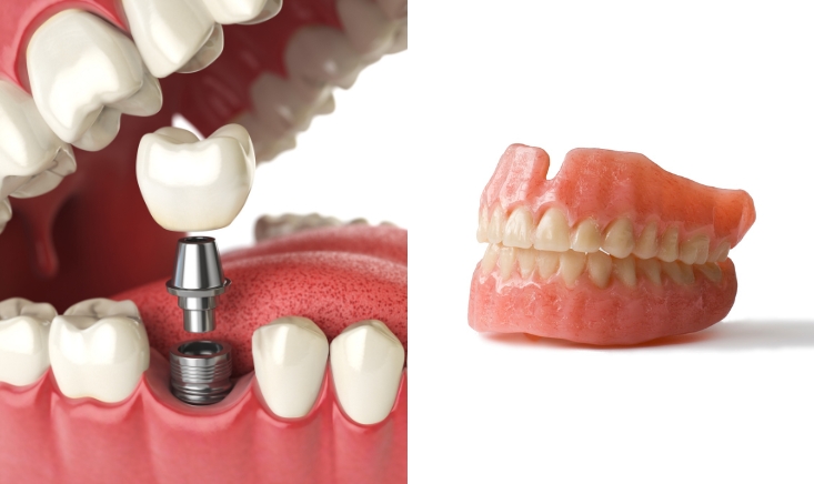 dental implants vs dentures which is for me